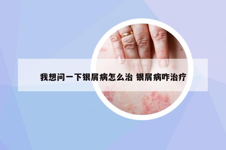 我想問一下銀屑病怎么治 銀屑病咋治療