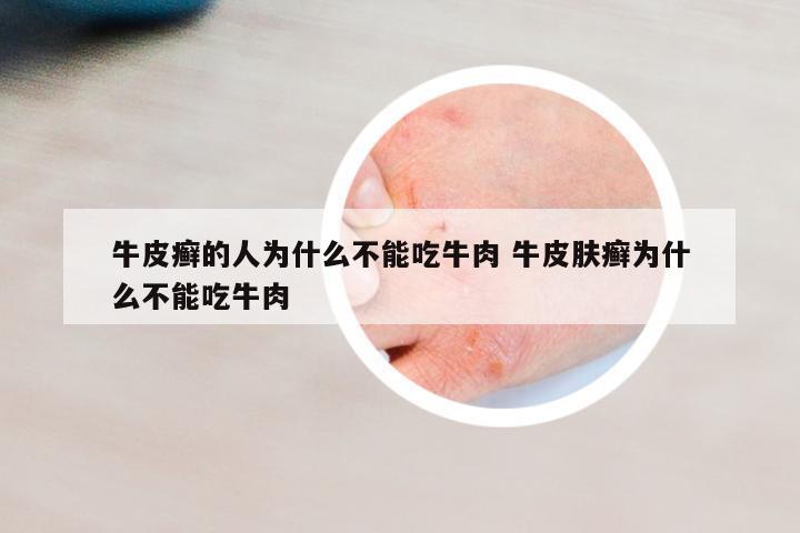 牛皮癬的人為什么不能吃牛肉 牛皮膚癬為什么不能吃牛肉