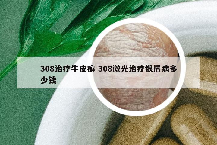 308治療牛皮癬 308激光治療銀屑病多少錢