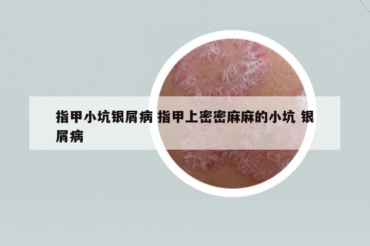 指甲小坑銀屑病 指甲上密密麻麻的小坑 銀屑病