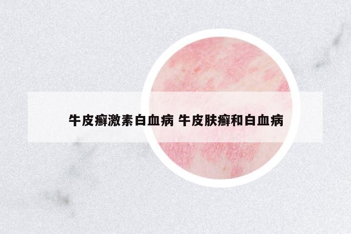 牛皮癬激素白血病 牛皮膚癬和白血病