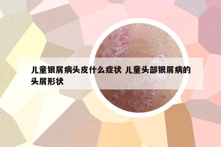 兒童銀屑病頭皮什么癥狀 兒童頭部銀屑病的頭屑形狀