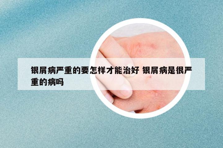 銀屑病嚴重的要怎樣才能治好 銀屑病是很嚴重的病嗎