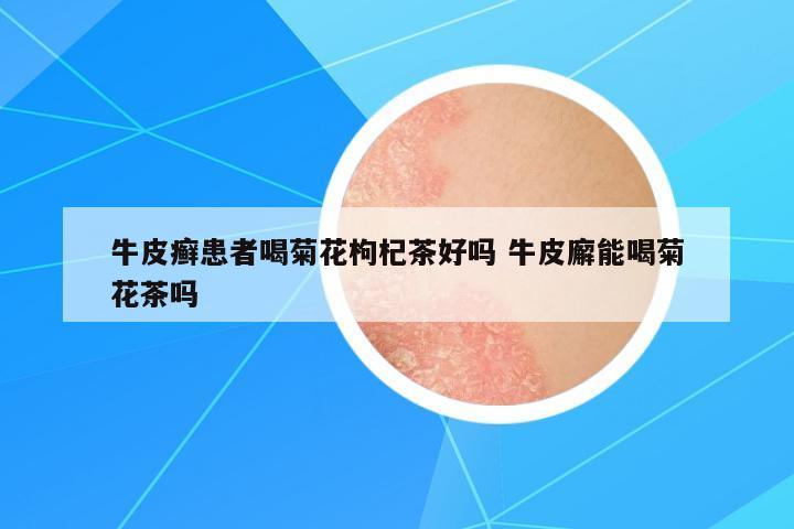 牛皮癬患者喝菊花枸杞茶好嗎 牛皮廨能喝菊花茶嗎