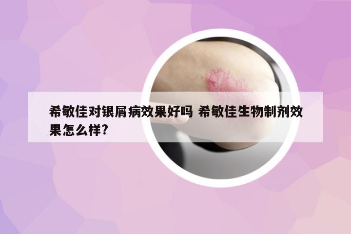 希敏佳對銀屑病效果好嗎 希敏佳生物制劑效果怎么樣?