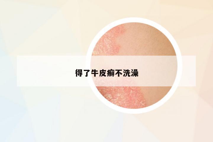 得了牛皮癬不洗澡