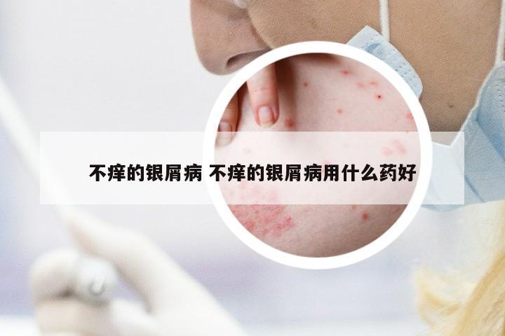 不癢的銀屑病 不癢的銀屑病用什么藥好