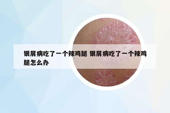 銀屑病吃了一個辣雞腿 銀屑病吃了一個辣雞腿怎么辦