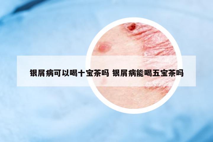 銀屑病可以喝十寶茶嗎 銀屑病能喝五寶茶嗎
