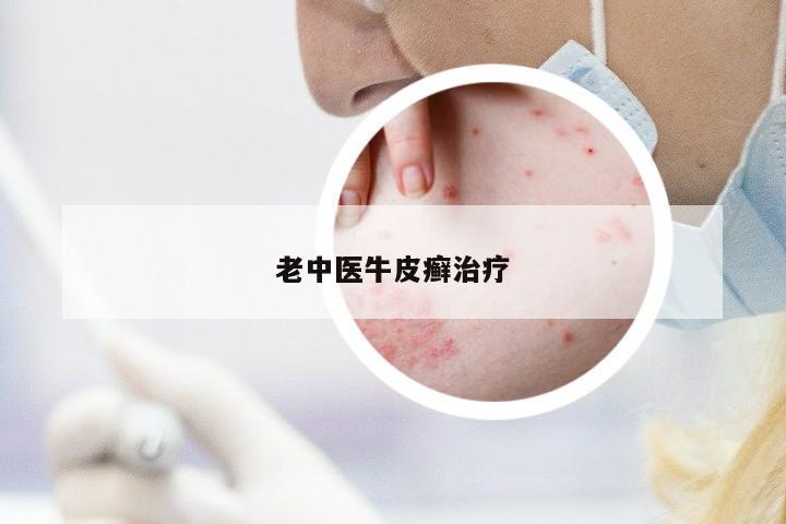 老中醫(yī)牛皮癬治療