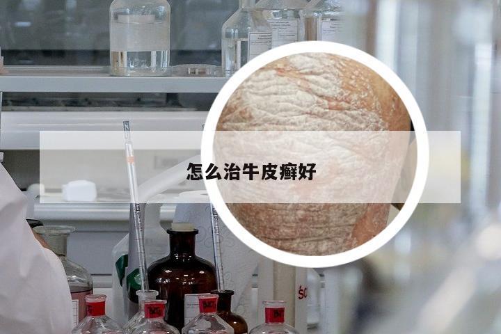 怎么治牛皮癬好