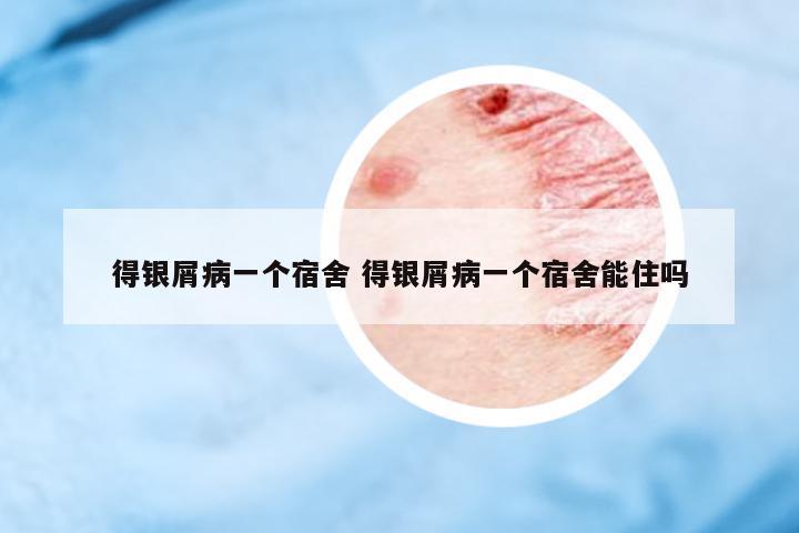 得銀屑病一個(gè)宿舍 得銀屑病一個(gè)宿舍能住嗎