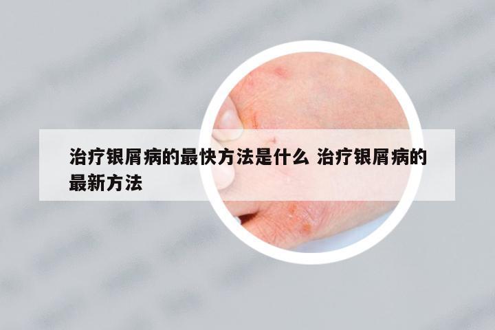 治療銀屑病的最快方法是什么 治療銀屑病的最新方法