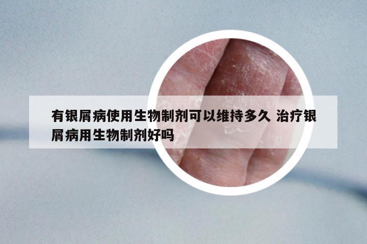 有銀屑病使用生物制劑可以維持多久 治療銀屑病用生物制劑好嗎