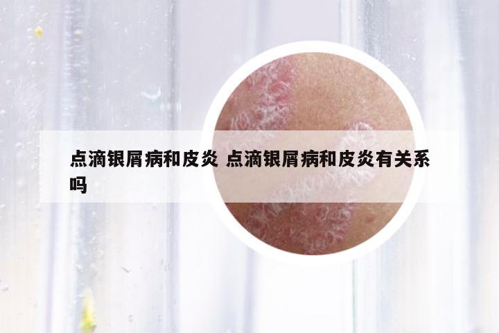 點(diǎn)滴銀屑病和皮炎 點(diǎn)滴銀屑病和皮炎有關(guān)系嗎