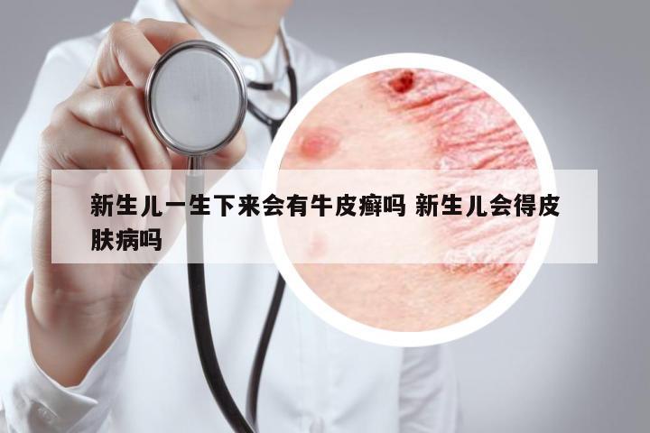 新生兒一生下來會(huì)有牛皮癬嗎 新生兒會(huì)得皮膚病嗎