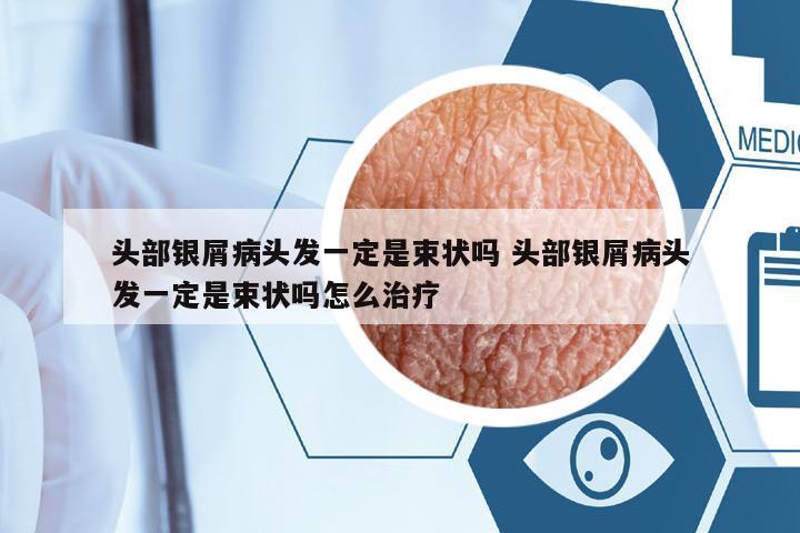 頭部銀屑病頭發(fā)一定是束狀嗎 頭部銀屑病頭發(fā)一定是束狀嗎怎么治療