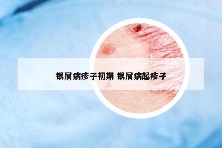 銀屑病疹子初期 銀屑病起疹子