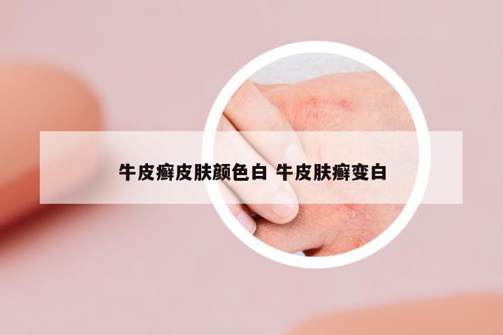 牛皮癬皮膚顏色白 牛皮膚癬變白
