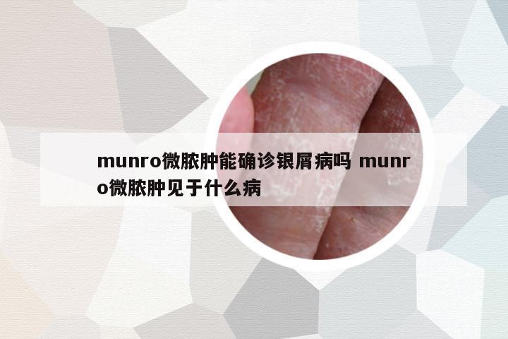 munro微膿腫能確診銀屑病嗎 munro微膿腫見于什么病