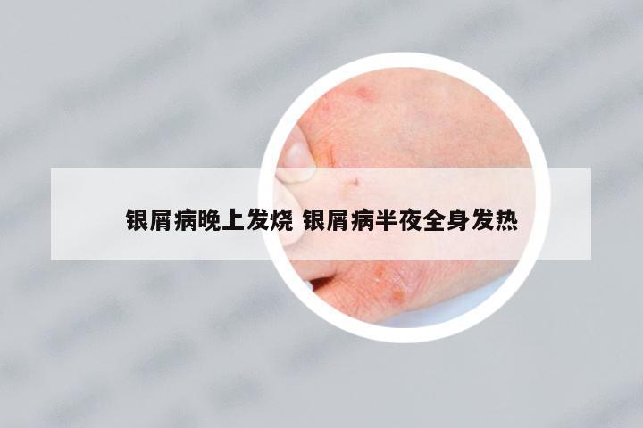 銀屑病晚上發(fā)燒 銀屑病半夜全身發(fā)熱