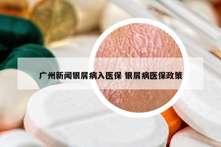 廣州新聞銀屑病入醫(yī)保 銀屑病醫(yī)保政策