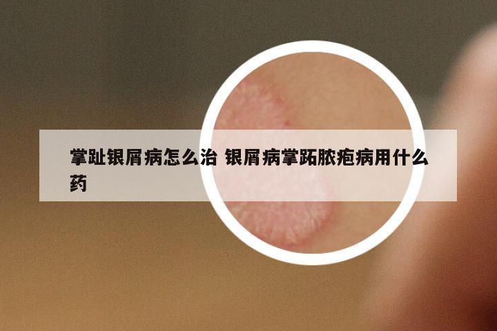 掌趾銀屑病怎么治 銀屑病掌跖膿皰病用什么藥