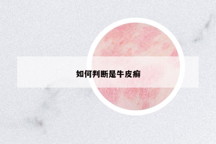 如何判斷是牛皮癬