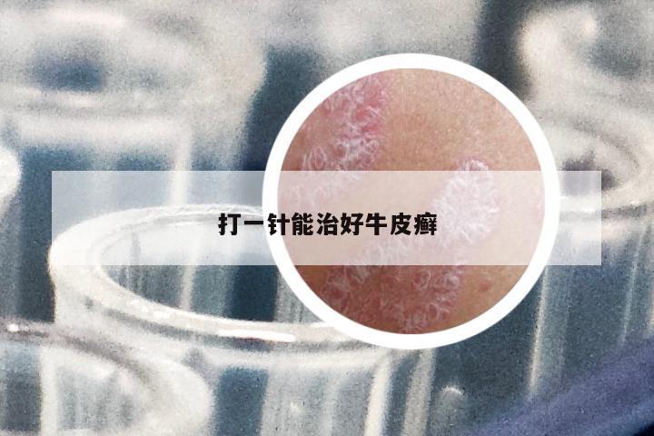打一針能治好牛皮癬