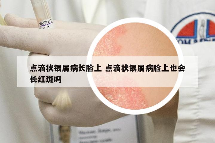點滴狀銀屑病長臉上 點滴狀銀屑病臉上也會長紅斑嗎