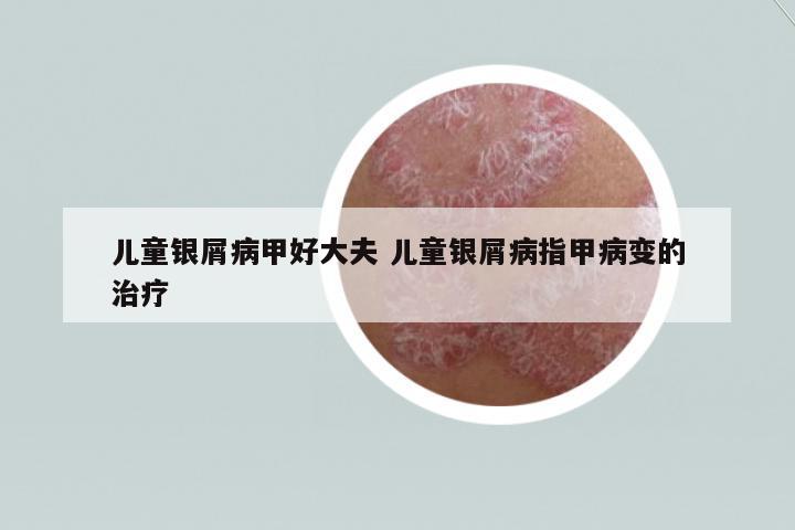 兒童銀屑病甲好大夫 兒童銀屑病指甲病變的治療
