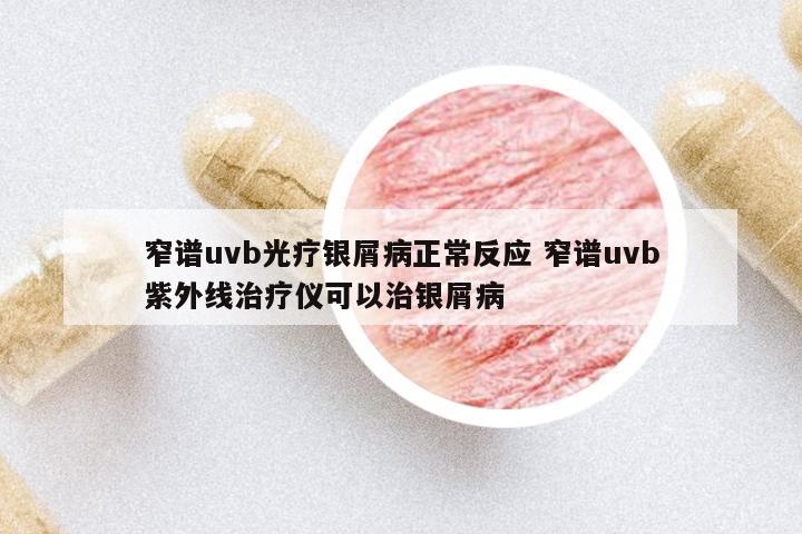 窄譜uvb光療銀屑病正常反應(yīng) 窄譜uvb紫外線治療儀可以治銀屑病