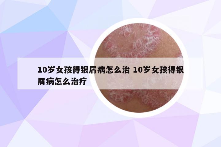 10歲女孩得銀屑病怎么治 10歲女孩得銀屑病怎么治療