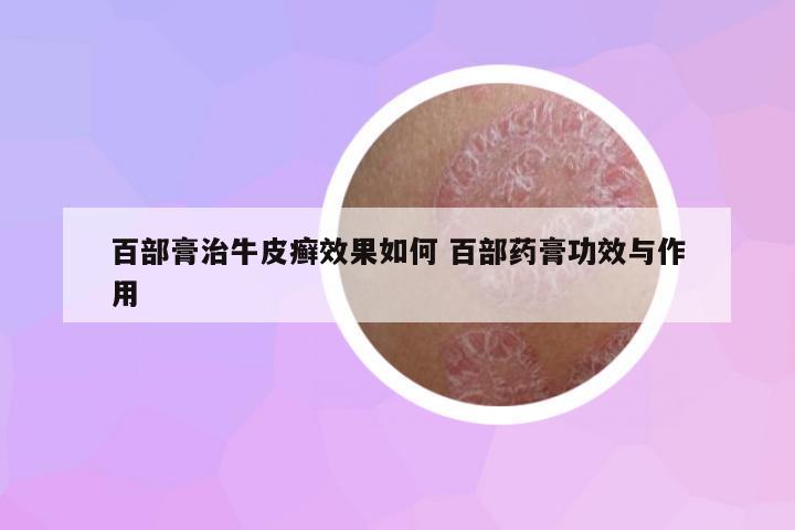 百部膏治牛皮癬效果如何 百部藥膏功效與作用