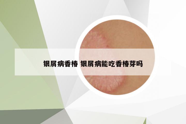 銀屑病香椿 銀屑病能吃香椿芽嗎