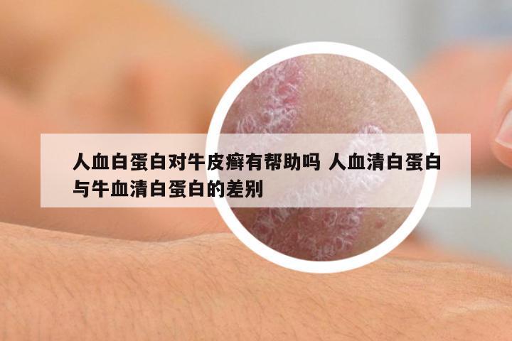 人血白蛋白對牛皮癬有幫助嗎 人血清白蛋白與牛血清白蛋白的差別