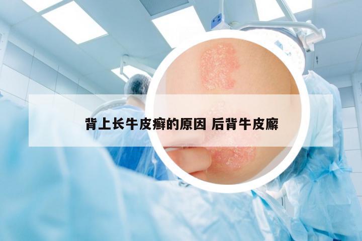 背上長(zhǎng)牛皮癬的原因 后背牛皮廨
