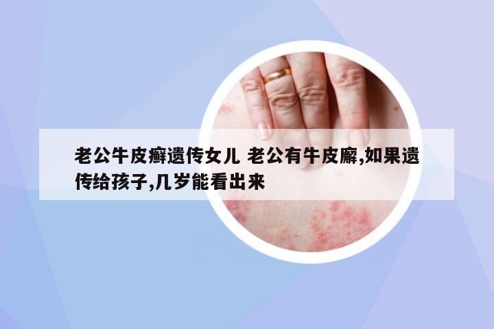 老公牛皮癬遺傳女兒 老公有牛皮廨,如果遺傳給孩子,幾歲能看出來(lái)
