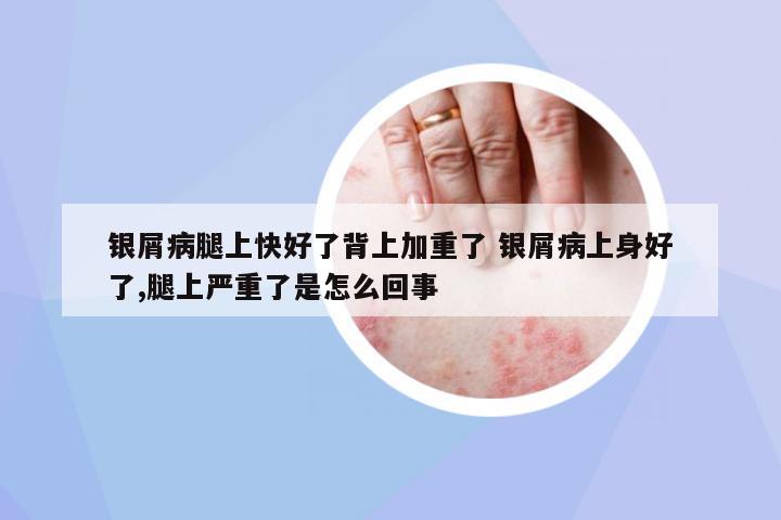 銀屑病腿上快好了背上加重了 銀屑病上身好了,腿上嚴(yán)重了是怎么回事