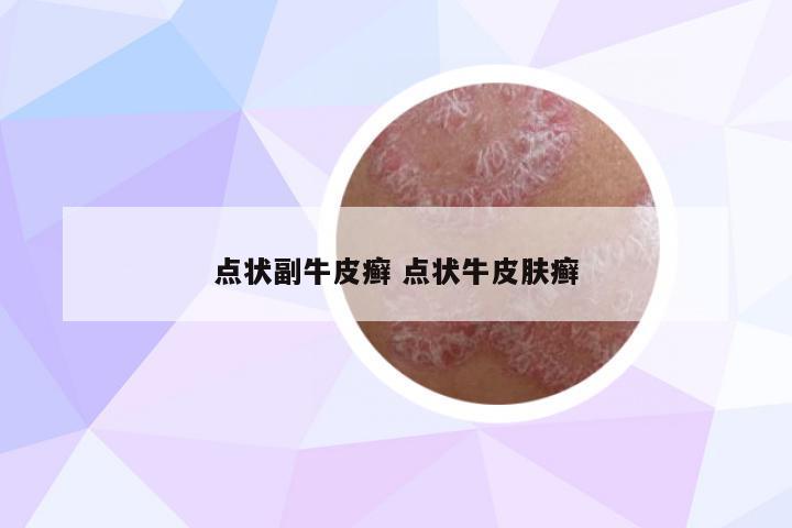 點(diǎn)狀副牛皮癬 點(diǎn)狀牛皮膚癬