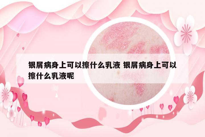 銀屑病身上可以擦什么乳液 銀屑病身上可以擦什么乳液呢