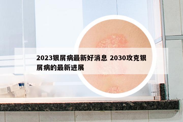 2023銀屑病最新好消息 2030攻克銀屑病的最新進(jìn)展