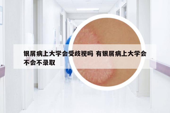 銀屑病上大學會受歧視嗎 有銀屑病上大學會不會不錄取