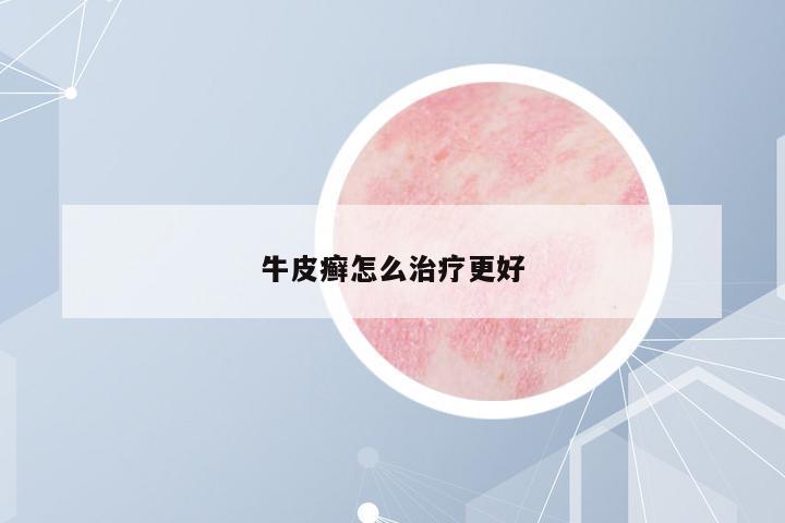 牛皮癬怎么治療更好