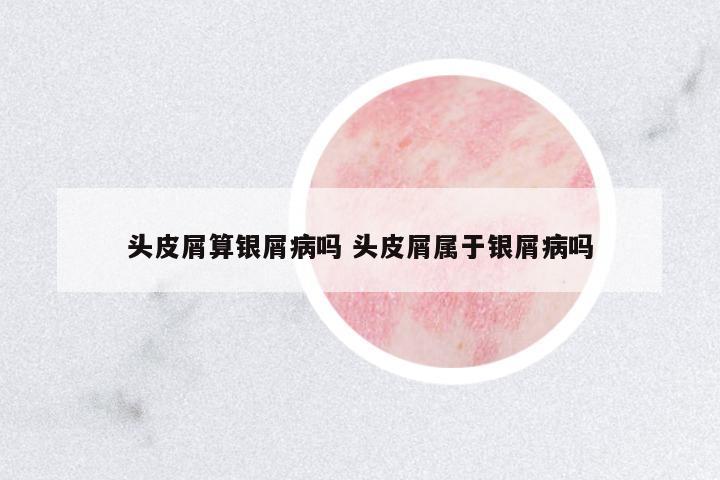 頭皮屑算銀屑病嗎 頭皮屑屬于銀屑病嗎