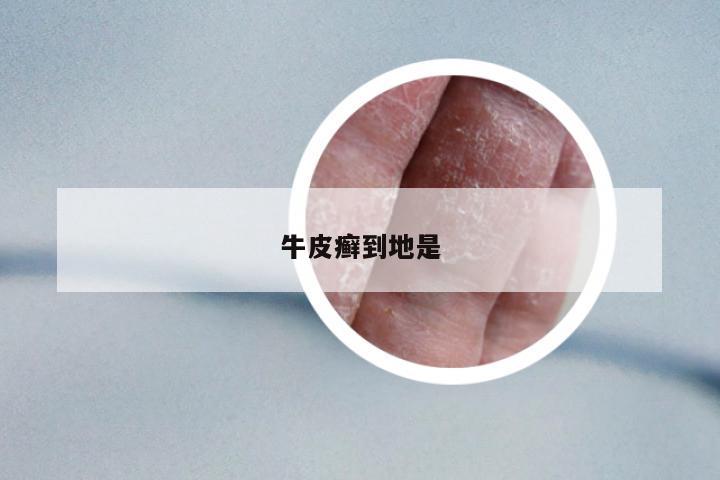 牛皮癬到地是