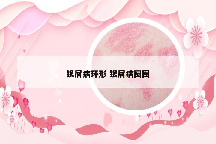銀屑病環(huán)形 銀屑病圓圈