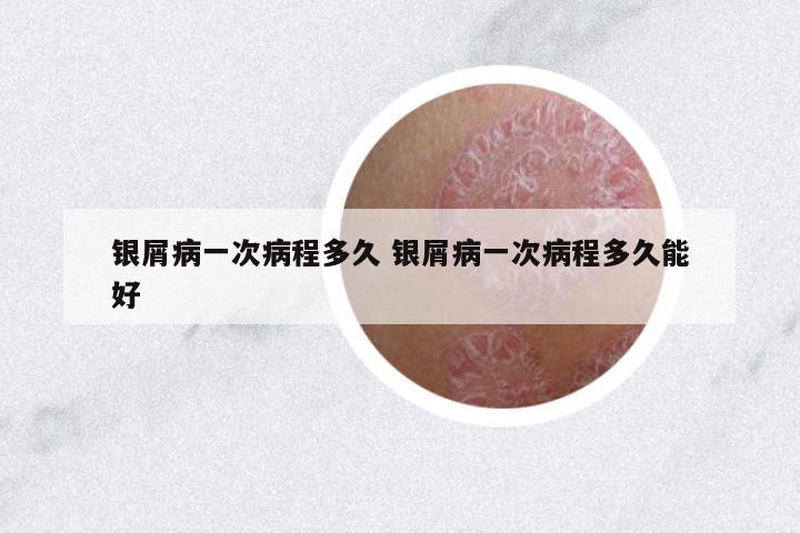 銀屑病一次病程多久 銀屑病一次病程多久能好