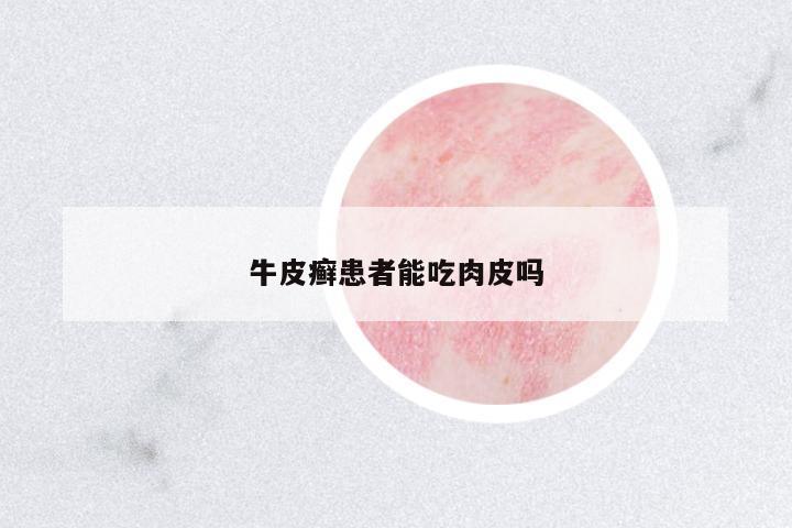 牛皮癬患者能吃肉皮嗎