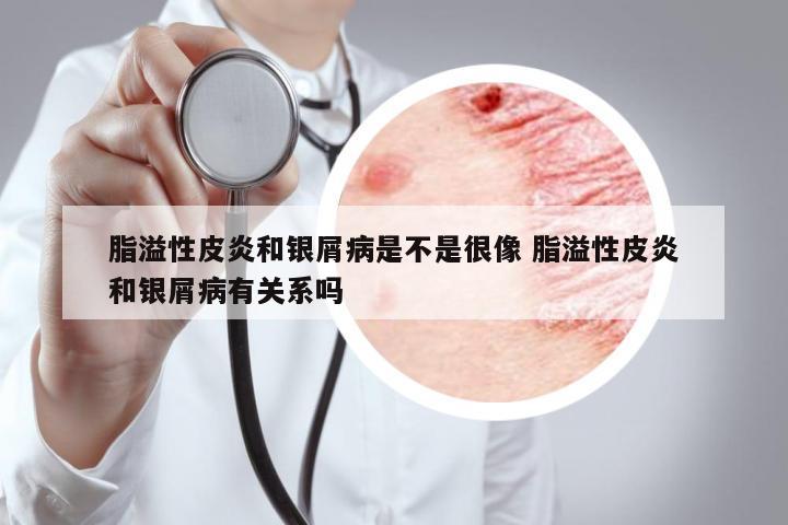 脂溢性皮炎和銀屑病是不是很像 脂溢性皮炎和銀屑病有關(guān)系嗎